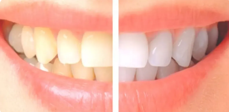 لن تتوقعها ..  6 أطعمة مفاجئة تحمي أسنانك