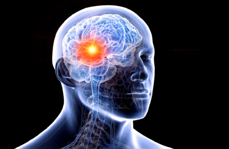 اكتشاف سبب غير متوقع يزيد خطر الإصابة بأورام الدماغ