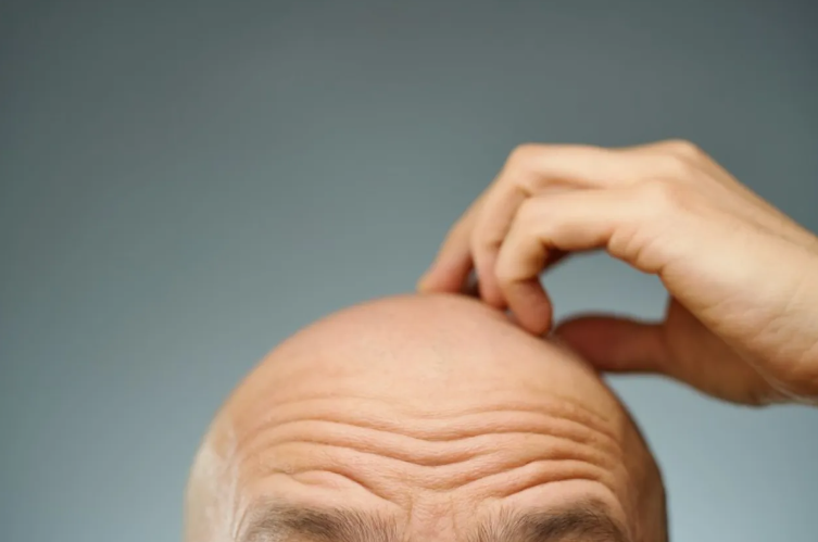 خبر سار للرجال ..  علاج موضعي للصلع يحفز نمو الشعر بنسبة 500%